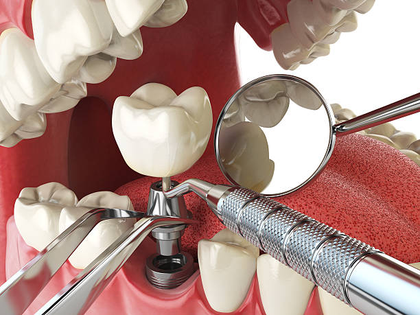 Best Lost Filling or Crown Replacement in Orida Gulf Coast University, FL